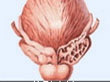前列腺增生治疗办法有哪些